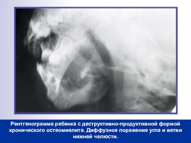 Рентгенограмма ребенка с деструктивно-продуктивной формой хронического остеомиелита. Диффузное поражение угла и ветви нижней челюсти.