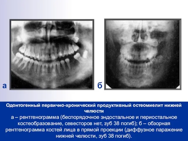 Одонтогенный первично-хронический продуктивный остеомиелит нижней челюсти а – рентгенограмма (беспорядочное эндостальное