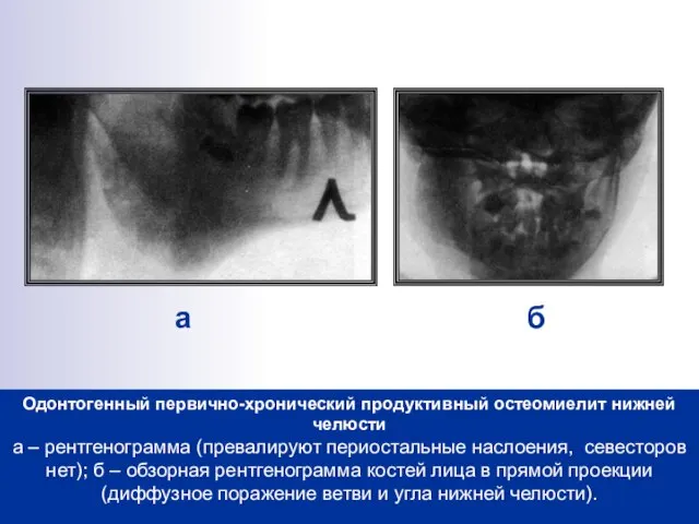 Одонтогенный первично-хронический продуктивный остеомиелит нижней челюсти а – рентгенограмма (превалируют периостальные