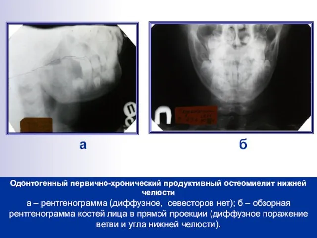 Одонтогенный первично-хронический продуктивный остеомиелит нижней челюсти а – рентгенограмма (диффузное, севесторов