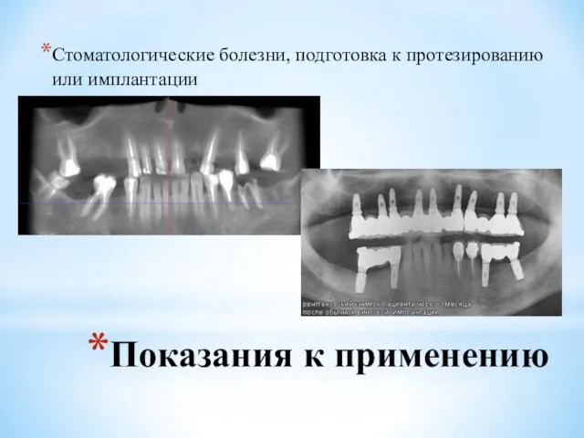 Показания к применению Стоматологические болезни, подготовка к протезированию или имплантации