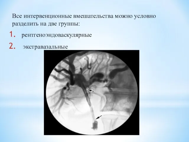 Все интервенционные вмешательства можно условно разделить на две группы: рентгеноэндоваскулярные экстравазальные