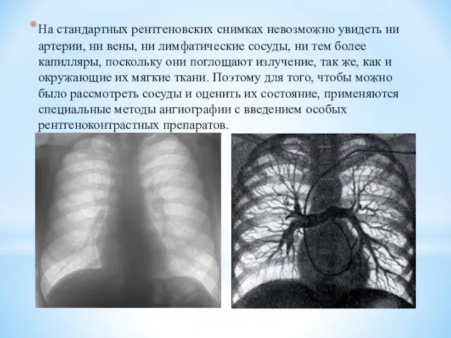 На стандартных рентгеновских снимках невозможно увидеть ни артерии, ни вены, ни