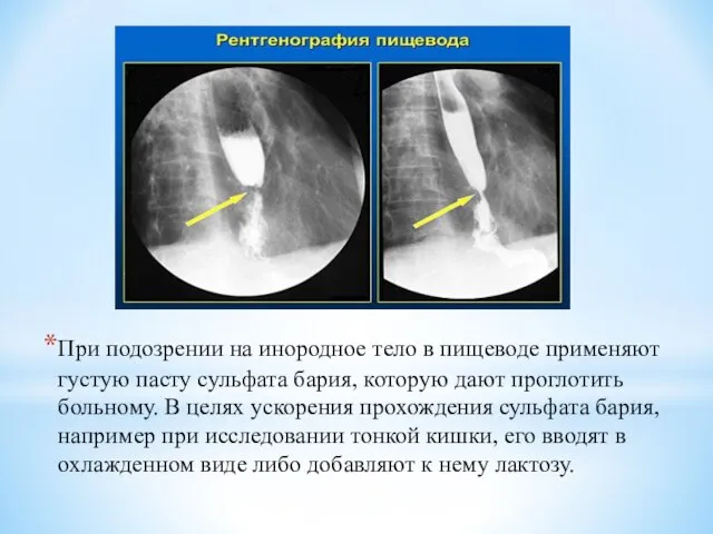 При подозрении на инородное тело в пищеводе применяют густую пасту сульфата