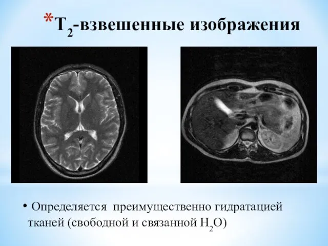 Т2-взвешенные изображения Определяется преимущественно гидратацией тканей (свободной и связанной H2O)