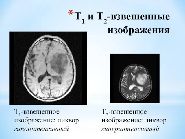 Т1 и Т2-взвешенные изображения Т1-взвешенное изображение: ликвор гипоинтенсивный Т2-взвешенное изображение: ликвор гиперинтенсивный