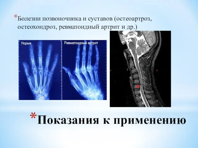 Показания к применению Болезни позвоночника и суставов (остеоартроз, остеохондроз, ревматоидный артрит и др.)