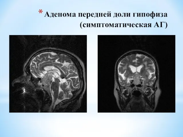 Аденома передней доли гипофиза (симптоматическая АГ)