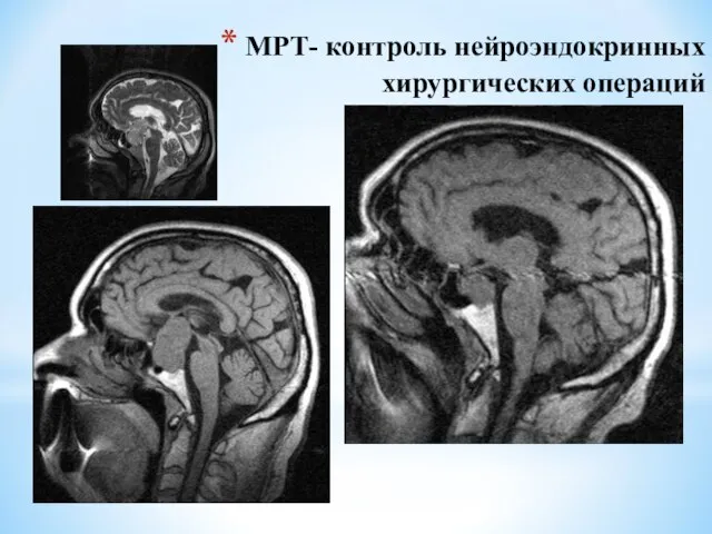 МРТ- контроль нейроэндокринных хирургических операций