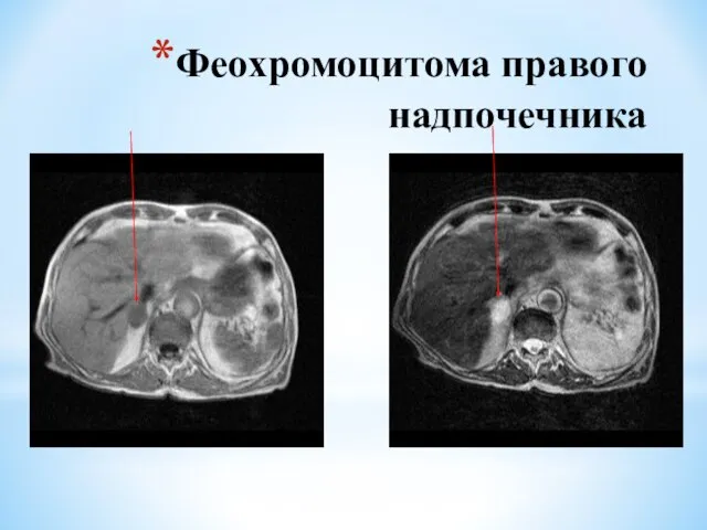 Феохромоцитома правого надпочечника