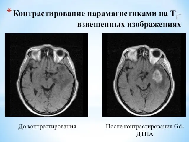 Контрастирование парамагнетиками на Т1-взвешенных изображениях До контрастирования После контрастирования Gd-ДТПА