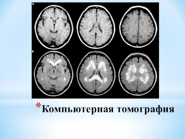 Компьютерная томография