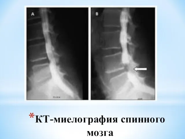 КТ-миелография спинного мозга