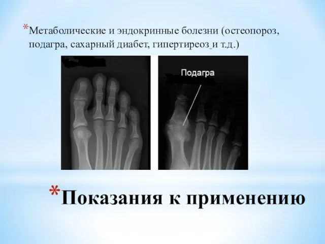 Показания к применению Метаболические и эндокринные болезни (остеопороз, подагра, сахарный диабет, гипертиреоз и т.д.)