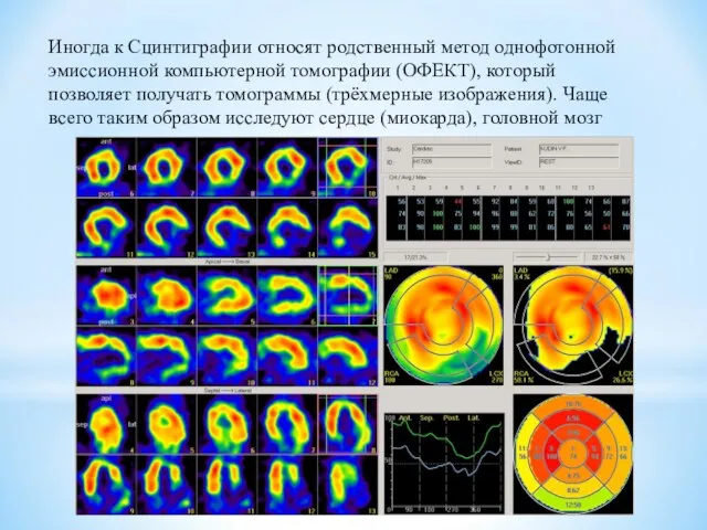 Иногда к Сцинтиграфии относят родственный метод однофотонной эмиссионной компьютерной томографии (ОФЕКТ),