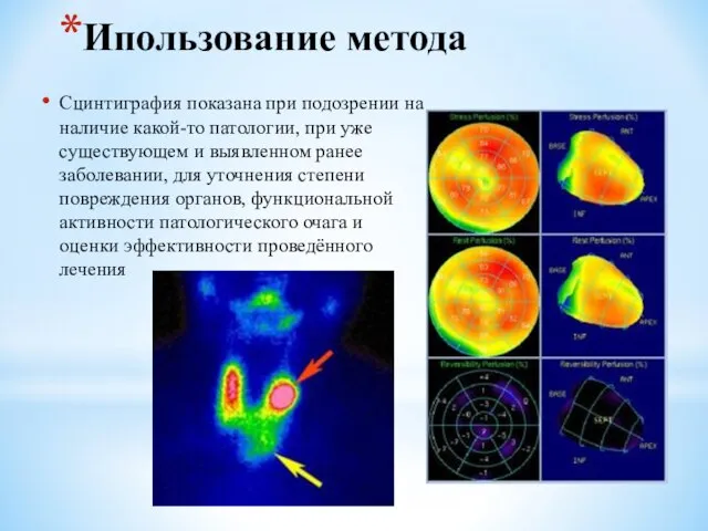 Ипользование метода Сцинтиграфия показана при подозрении на наличие какой-то патологии, при