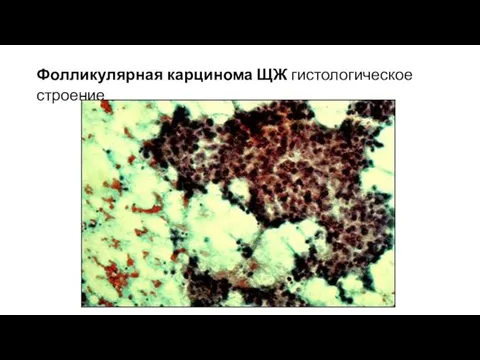 Фолликулярная карцинома ЩЖ гистологическое строение