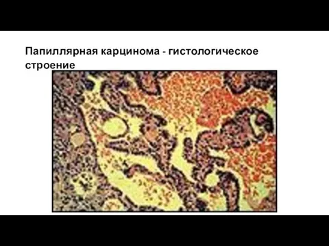 Папиллярная карцинома - гистологическое строение