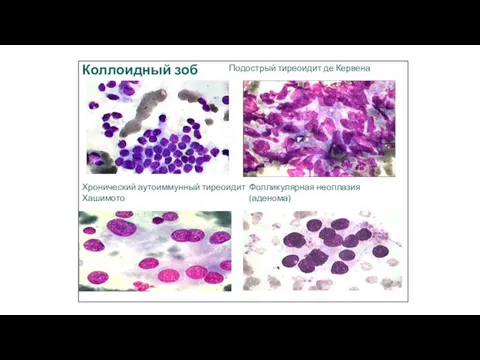 Коллоидный зоб Хронический аутоиммунный тиреоидит Хашимото Подострый тиреоидит де Кервена Фолликулярная неоплазия (аденома)