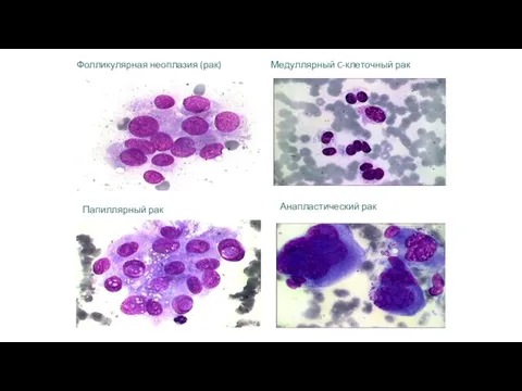 Фолликулярная неоплазия (рак) Папиллярный рак Медуллярный C-клеточный рак Анапластический рак