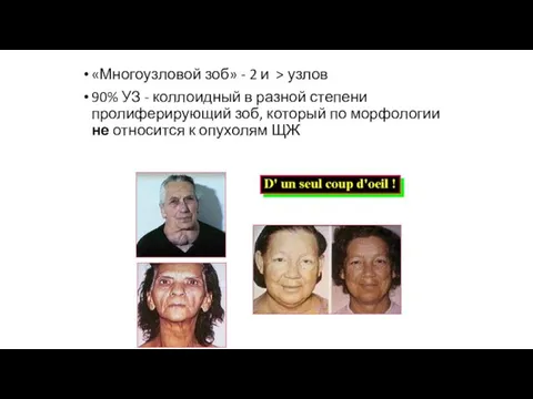 «Многоузловой зоб» - 2 и > узлов 90% УЗ - коллоидный