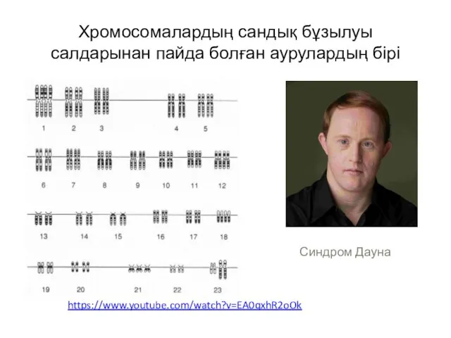 Хромосомалардың сандық бұзылуы салдарынан пайда болған аурулардың бірі Синдром Дауна https://www.youtube.com/watch?v=EA0qxhR2oOk