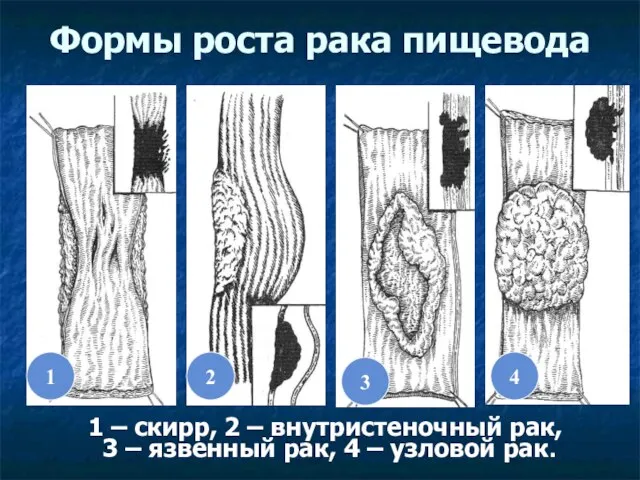 Формы роста рака пищевода 2 4 3 1 1 – скирр,