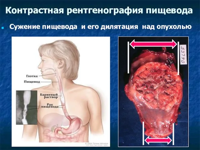 Контрастная рентгенография пищевода Сужение пищевода и его дилятация над опухолью