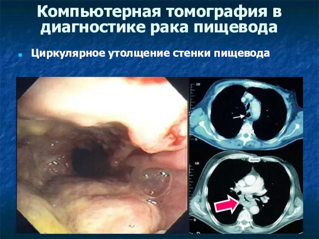 Компьютерная томография в диагностике рака пищевода Циркулярное утолщение стенки пищевода