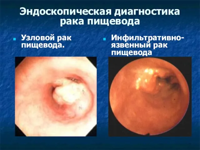 Эндоскопическая диагностика рака пищевода Узловой рак пищевода. Инфильтративно-язвенный рак пищевода