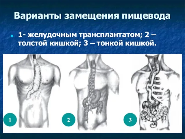 Варианты замещения пищевода 1- желудочным трансплантатом; 2 – толстой кишкой; 3