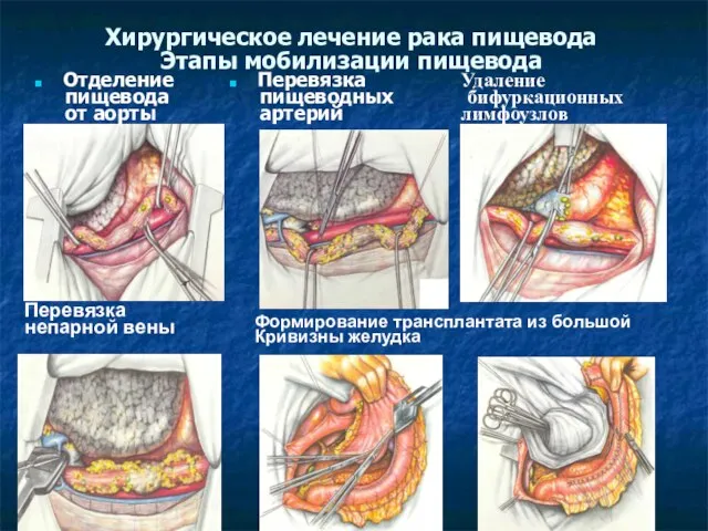 Хирургическое лечение рака пищевода Этапы мобилизации пищевода Отделение пищевода от аорты