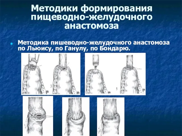 Методики формирования пищеводно-желудочного анастомоза Методика пишеводно-желудочного анастомоза по Льюису, по Ганулу, по Бондарю.