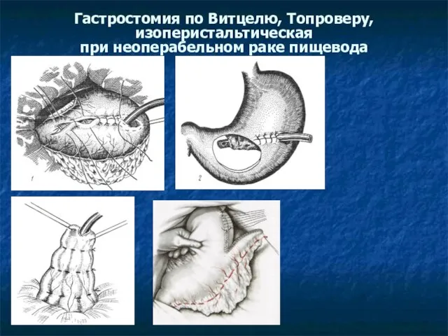 Гастростомия по Витцелю, Топроверу, изоперистальтическая при неоперабельном раке пищевода