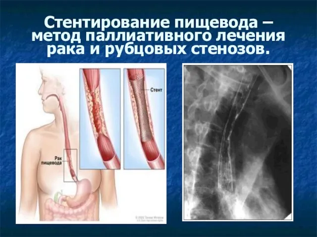 Cтентирование пищевода – метод паллиативного лечения рака и рубцовых стенозов.