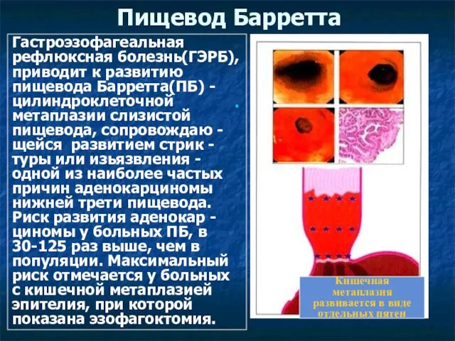 Пищевод Барретта Гастроэзофагеальная рефлюксная болезнь(ГЭРБ), приводит к развитию пищевода Барретта(ПБ) -