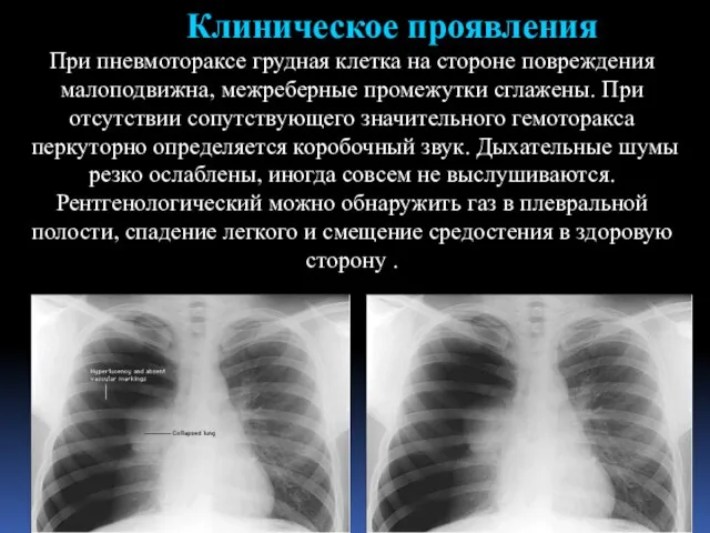 Клиническое проявления При пневмотораксе грудная клетка на стороне повреждения малоподвижна, межреберные