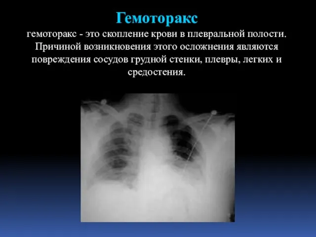 Гемоторакс гемоторакс - это скопление крови в плевральной полости. Причиной возникновения