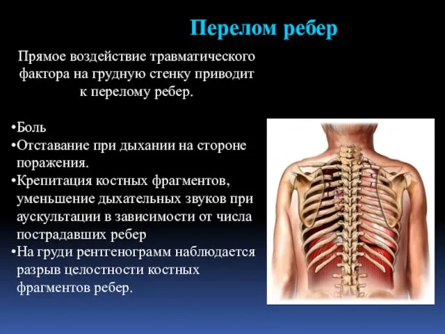 Прямое воздействие травматического фактора на грудную стенку приводит к перелому ребер.