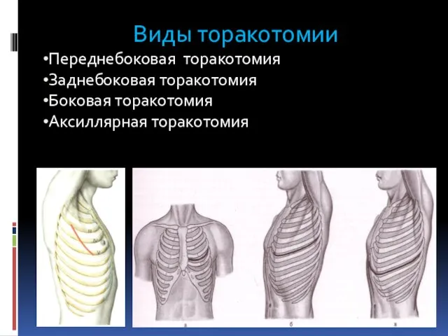 Виды торакотомии Переднебоковая торакотомия Заднебоковая торакотомия Боковая торакотомия Аксиллярная торакотомия