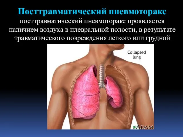 Посттравматический пневмоторакс посттравматический пневмоторакс проявляется наличием воздуха в плевральной полости, в