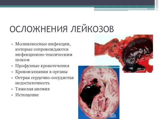 ОСЛОЖНЕНИЯ ЛЕЙКОЗОВ Молниеносные инфекции, которые сопровождаются инфекционно-токсическим шоком Профузные кровотечения Кровоизлияния