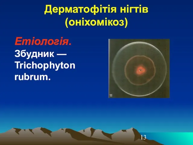 Дерматофітія нігтів (оніхомікоз) Етіологія. Збудник — Trichoрhyton rubrum.