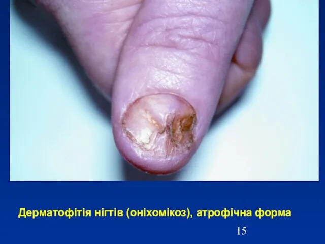 Дерматофітія нігтів (оніхомікоз), атрофічна форма