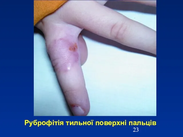 Руброфітія тильної поверхні пальців