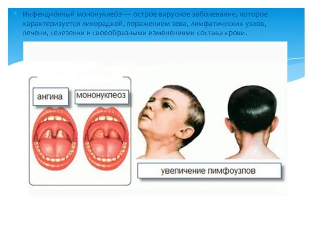 Инфекцио́нный мононуклео́з — острое вирусное заболевание, которое характеризуется лихорадкой, поражением зева,