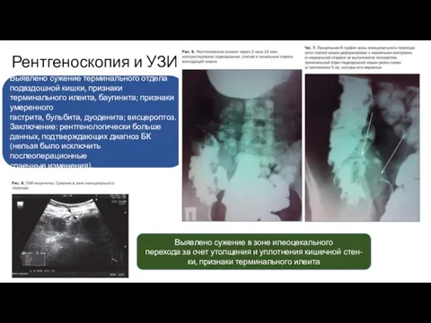 Рентгеноскопия и УЗИ Выявлено сужение терминального отдела подвздошной кишки, признаки терминального