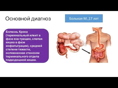 Основной диагноз Болезнь Крона (терминальный илеит в фазе язв-трещин, слепая кишка