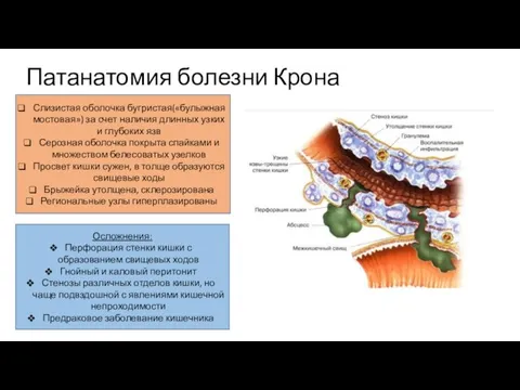 Патанатомия болезни Крона Слизистая оболочка бугристая(«булыжная мостовая») за счет наличия длинных