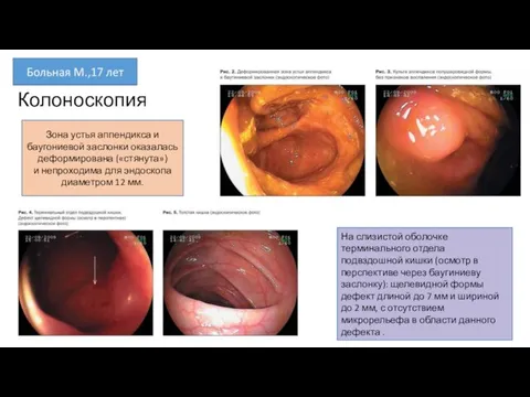 Колоноскопия На слизистой оболочке терминального отдела подвздошной кишки (осмотр в перспективе